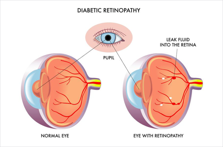 Diabetic Retinopathy