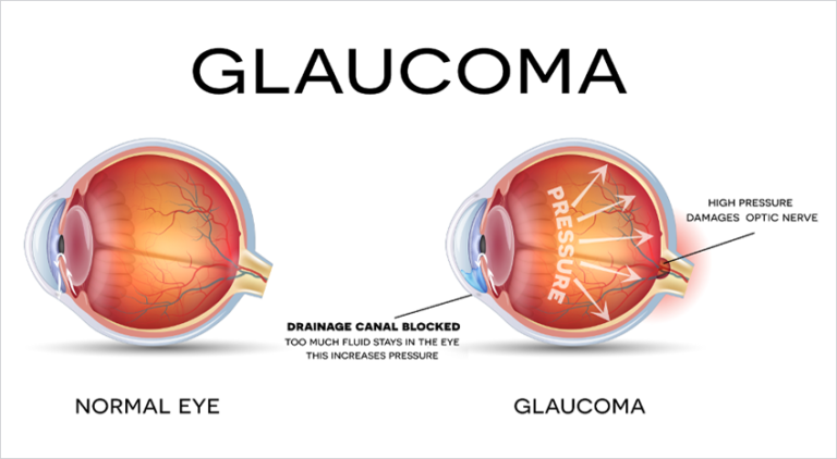 Glaucoma