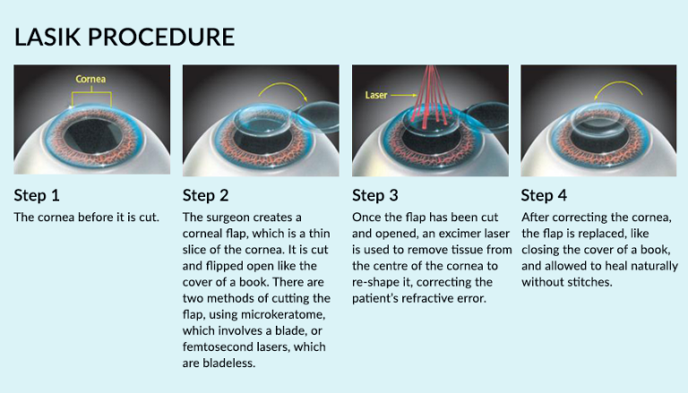 What is LASIK