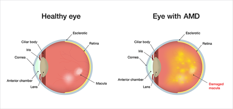 Macular Degeneration