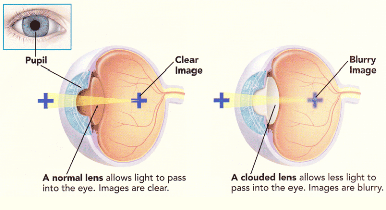 Cataract